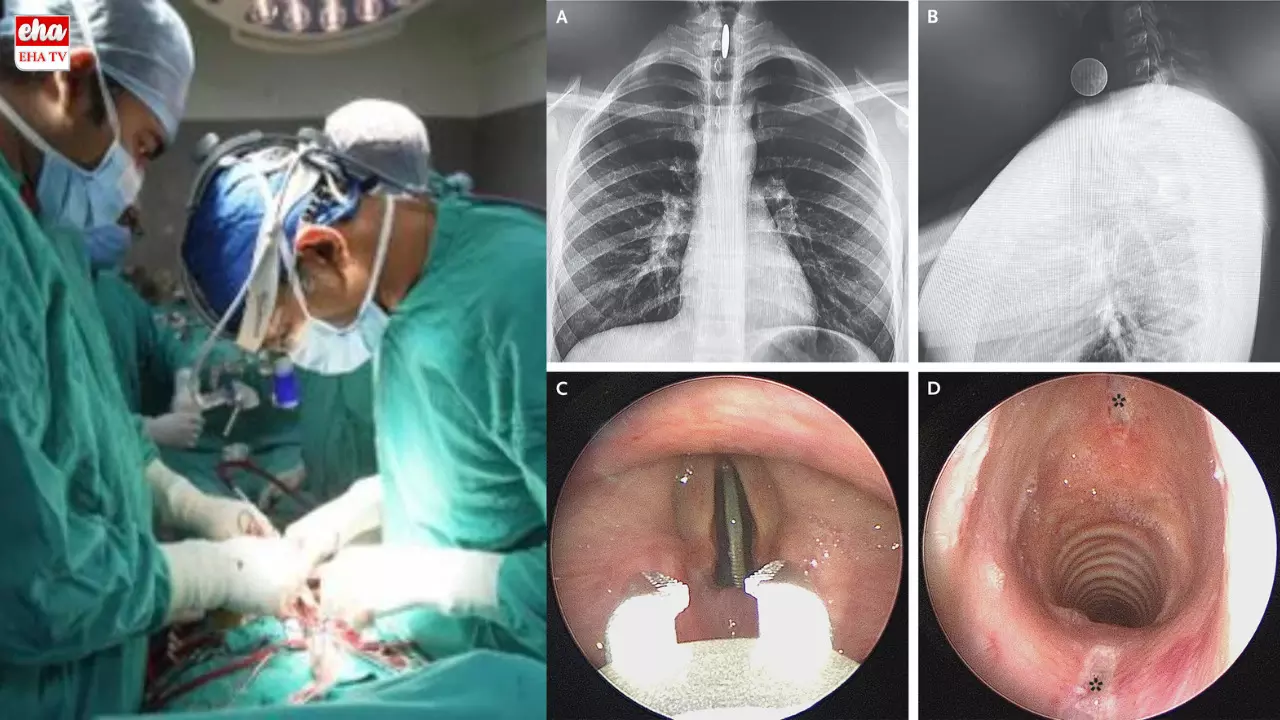 Coin In Trachea : ఎనిమిదేళ్లుగా శ్వాసనాళంలో పావలాబిళ్ల...!