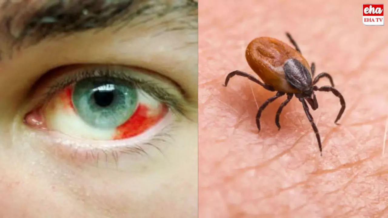 Eye Bleeding Virus : పాక్‌లో వెలుగు చూసిన ప్రమాదకరమైన వైరస్‌.. మనకూ సోకవచ్చు!