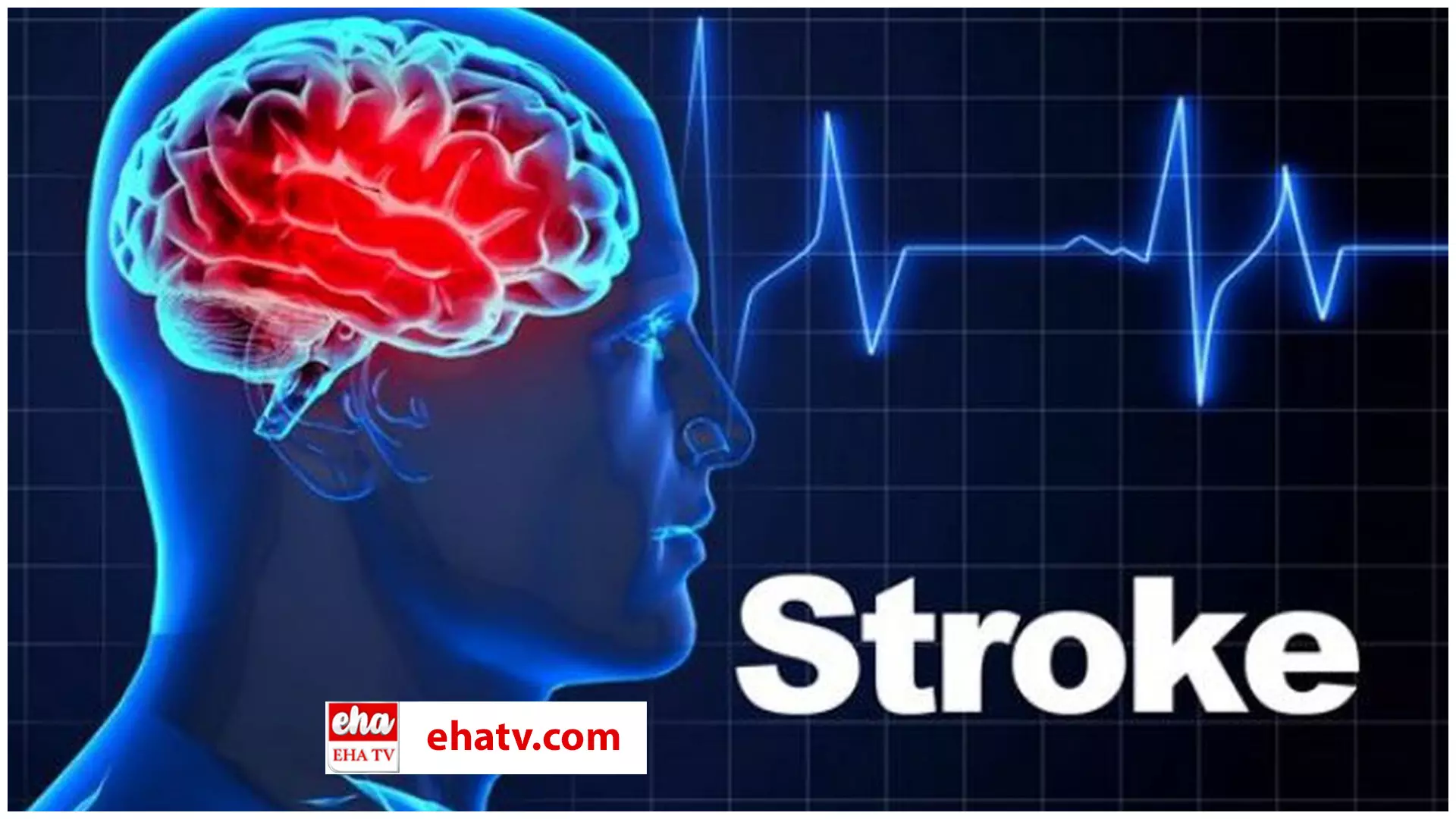 Symptoms of Brain Stroke :  బ్రెయిన్‌ స్ట్రోక్ వచ్చే ముందు మనకు కనిపించే లక్షణాలు